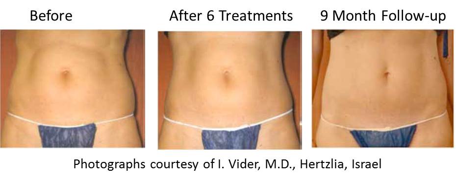 Body Contouring and Skin Tightening Treatment in Crown Point IN
